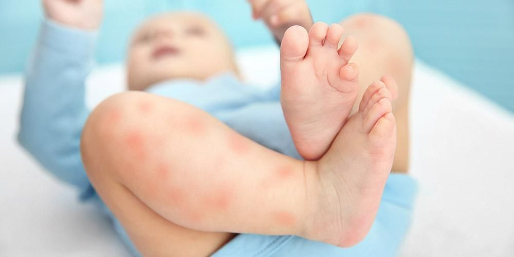 Kenali dari Awal Faktor Penyebab Alergi Pada Bayi