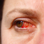 penyebab mata merah