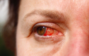 penyebab mata merah