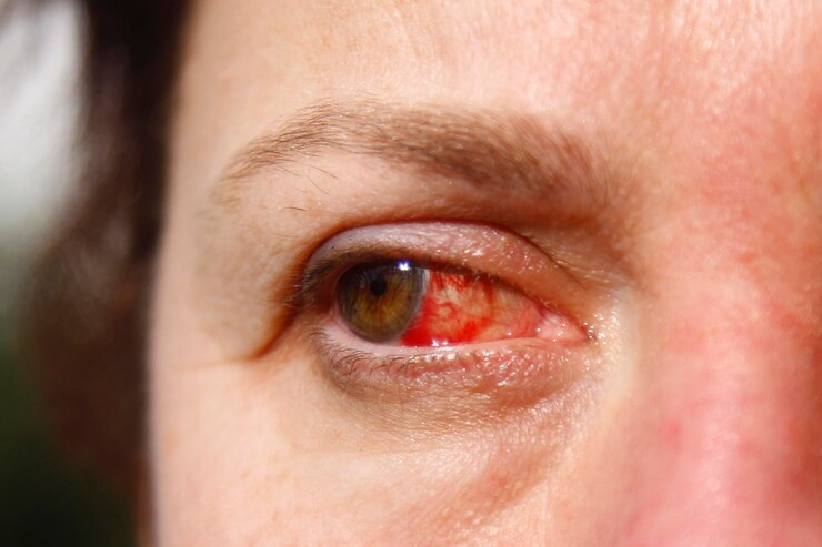 Penyebab Mata Merah karena Kelelahan dan Cara Mengatasinya